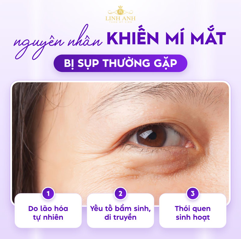 Mí sụp có nên phun mí không? Phương pháp cải thiện HIỆU QUẢ 18 Mí mắt bị sụp nên phun mí