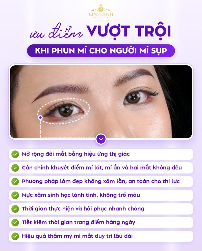 Mí sụp có nên phun mí không? Phương pháp cải thiện HIỆU QUẢ 19 Phun mí cho người sụp mí mắt